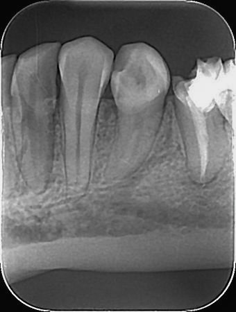 mali snimak pojedinačnog zuba sa dva susedna