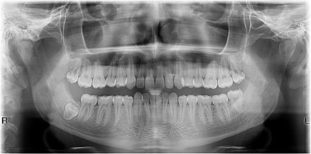 ortopantomogram-ortopan snimak svih zuba