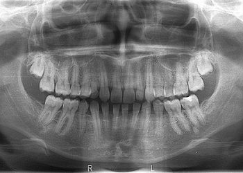 digitalni ortopan radiološki snimak svih zuba i cele vilice